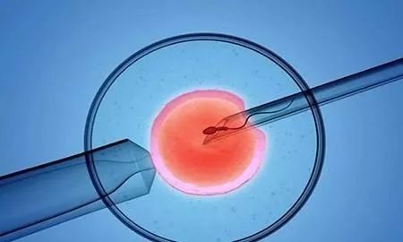 不孕专题—多囊卵巢综合征