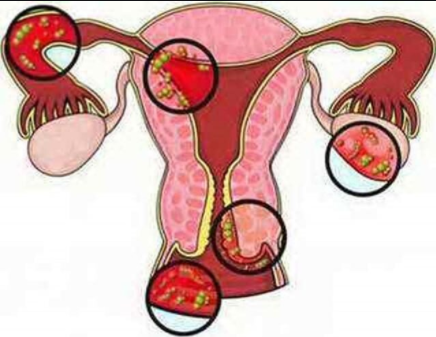 不孕之盆腔炎性疾病后遗症