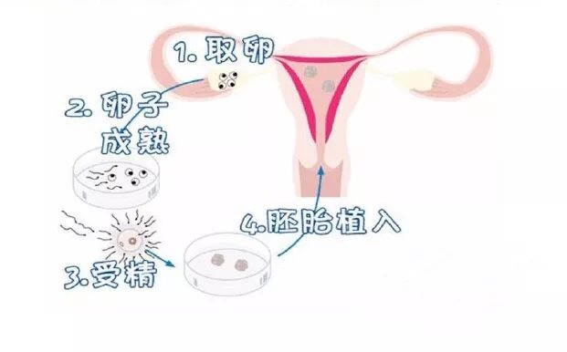 什么是取卵？取卵的全过程