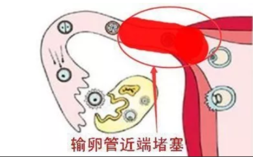 输卵管通不通，每一个备孕人都要科学的看待