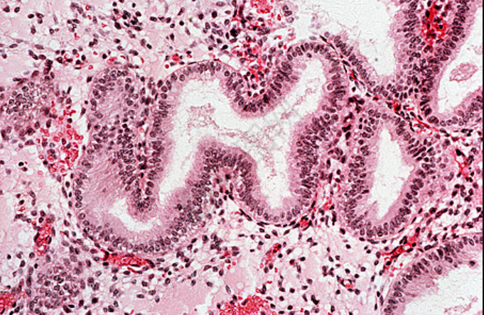 子宫内膜分型ABC,到底是指什么呢?